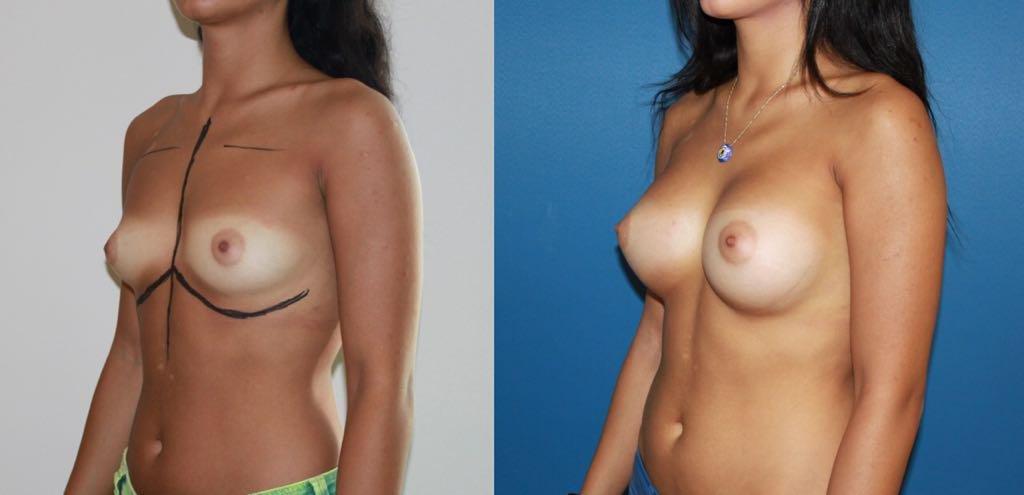 Before and after result by Dr. Çağrı Sade