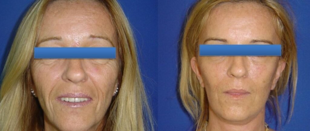 Before and after result by Dr. Çağrı Sade