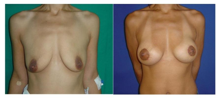 Before and after result by Dr. Çağrı Sade