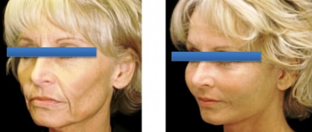 Before and after result by Dr. Çağrı Sade