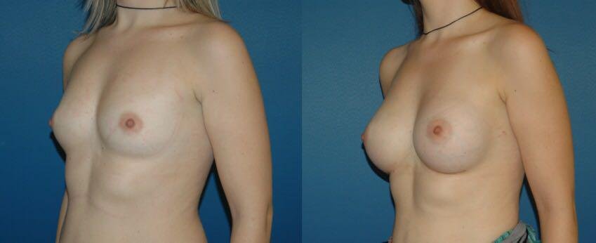 Before and after result by Dr. Çağrı Sade