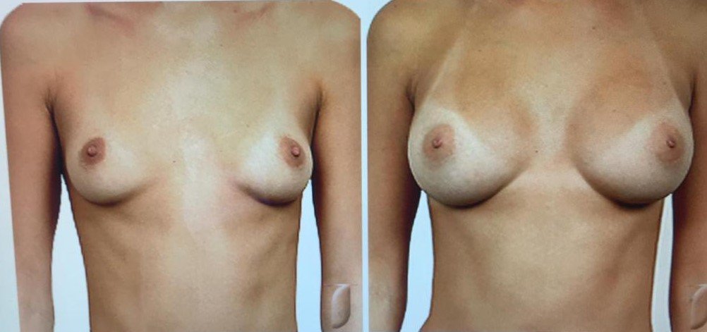 Before and after result by Dr. Çağrı Sade