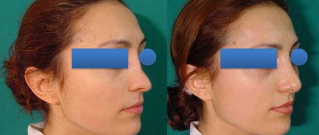 Before and after result by Dr. Çağrı Sade