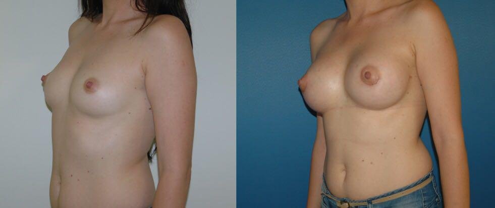 Before and after result by Dr. Çağrı Sade