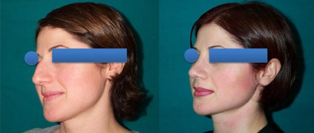 Before and after result by Dr. Çağrı Sade