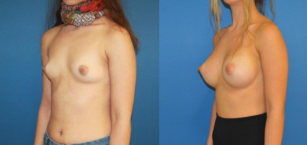 Before and after result by Dr. Çağrı Sade