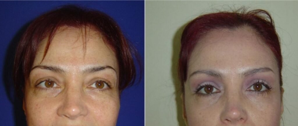 Before and after result by Dr. Çağrı Sade