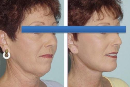 Before and after result by Dr. Çağrı Sade