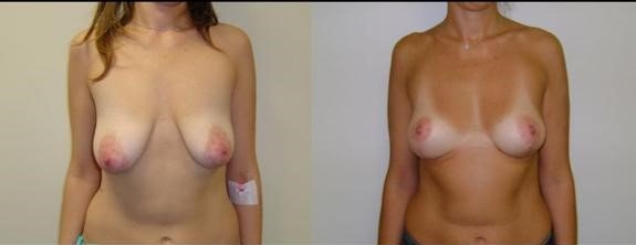 Before and after result by Dr. Çağrı Sade