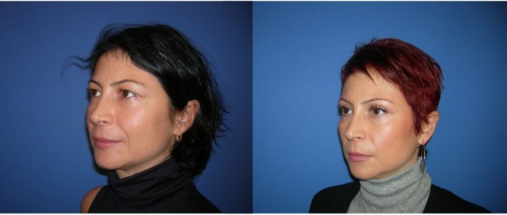 Before and after result by Dr. Çağrı Sade