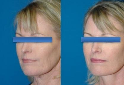 Before and after result by Dr. Çağrı Sade