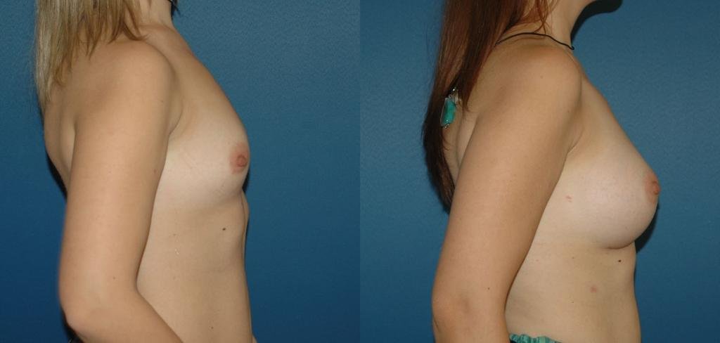 Before and after result by Dr. Çağrı Sade