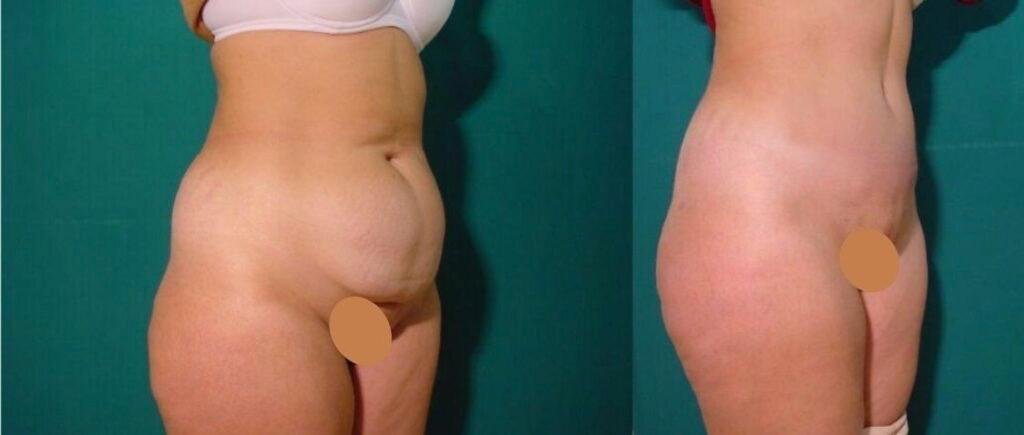 Before and after result by Dr. Çağrı Sade