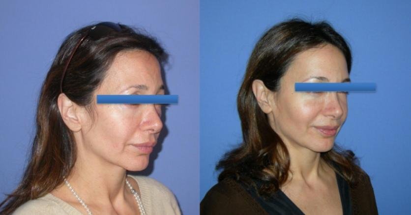 Before and after result by Dr. Çağrı Sade