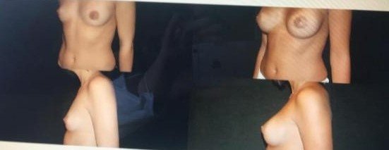 Before and after result by Dr. Çağrı Sade