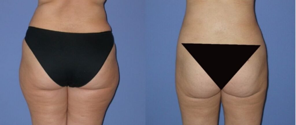 Before and after result by Dr. Çağrı Sade