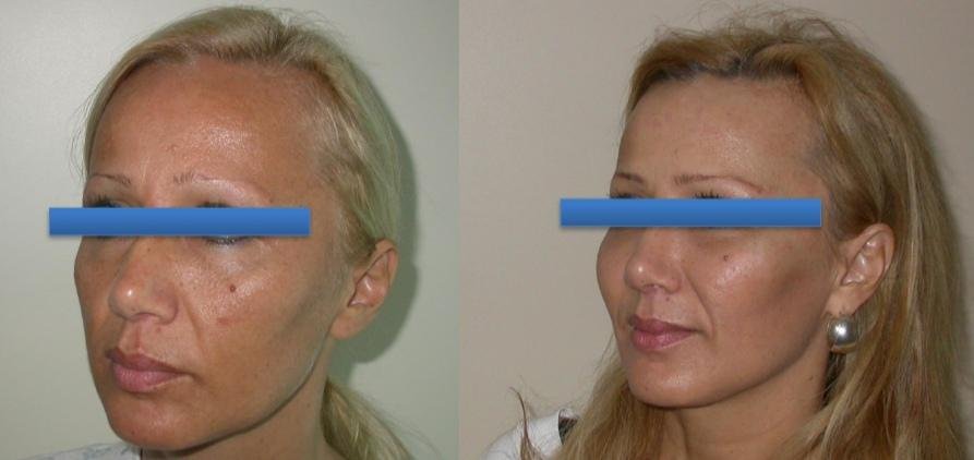 Before and after result by Dr. Çağrı Sade