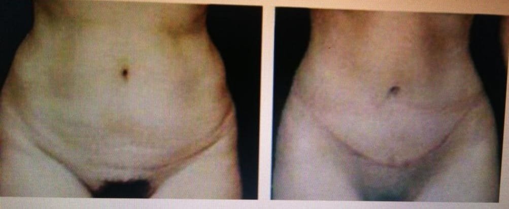 Before and after result by Dr. Çağrı Sade