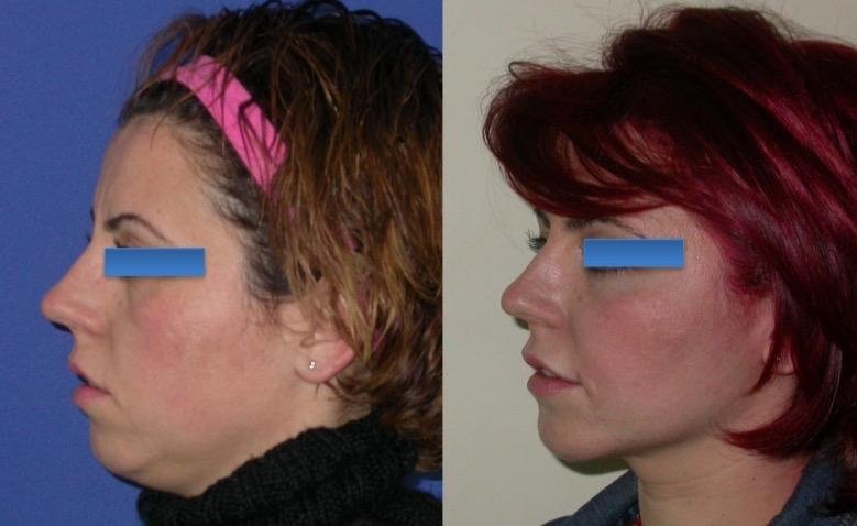 Before and after result by Dr. Çağrı Sade