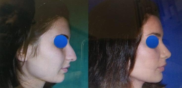 Before and after result by Dr. Çağrı Sade