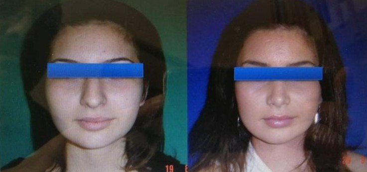 Before and after result by Dr. Çağrı Sade