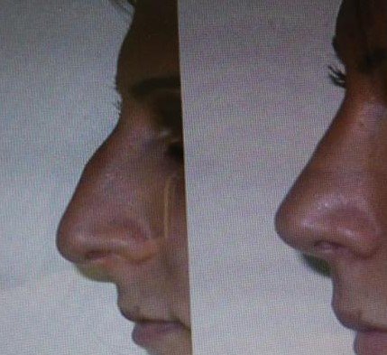 Before and after result by Dr. Çağrı Sade