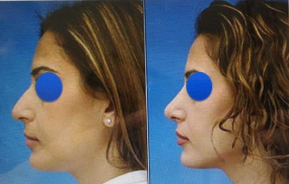 Before and after result by Dr. Çağrı Sade