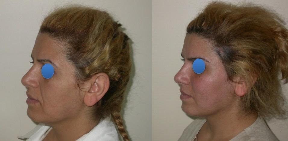 Before and after result by Dr. Çağrı Sade