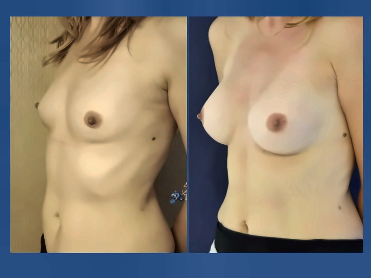 Before and after result by Dr. Ergin Er