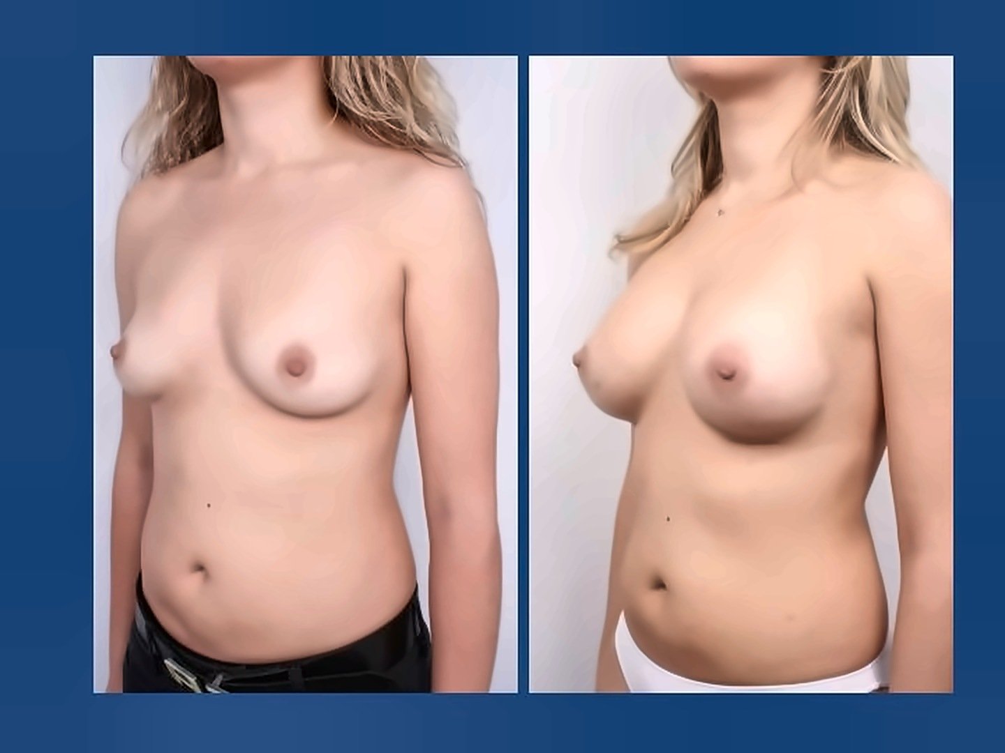 Before and after result by Dr. Ergin Er