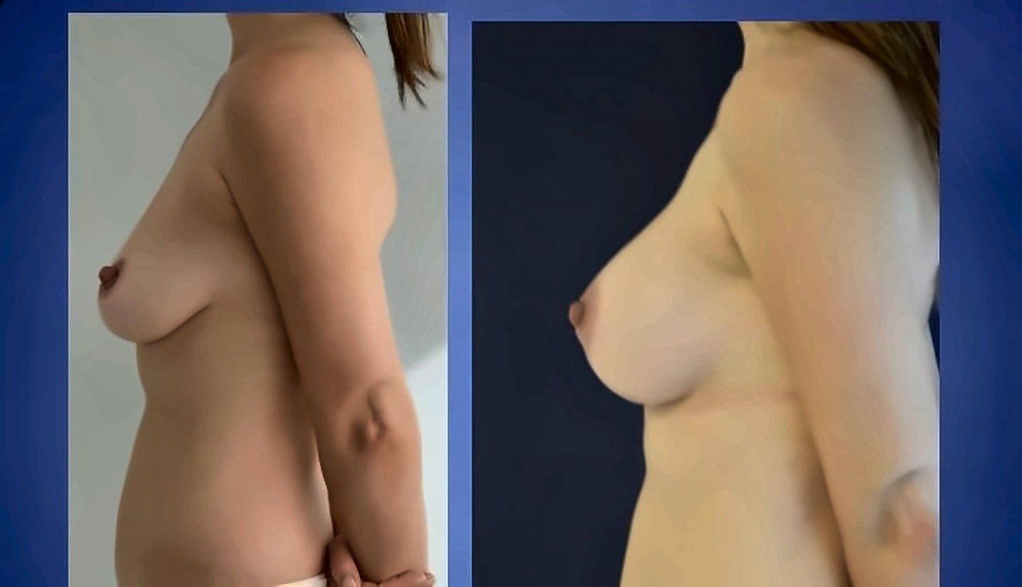 Before and after result by Dr. Ergin Er