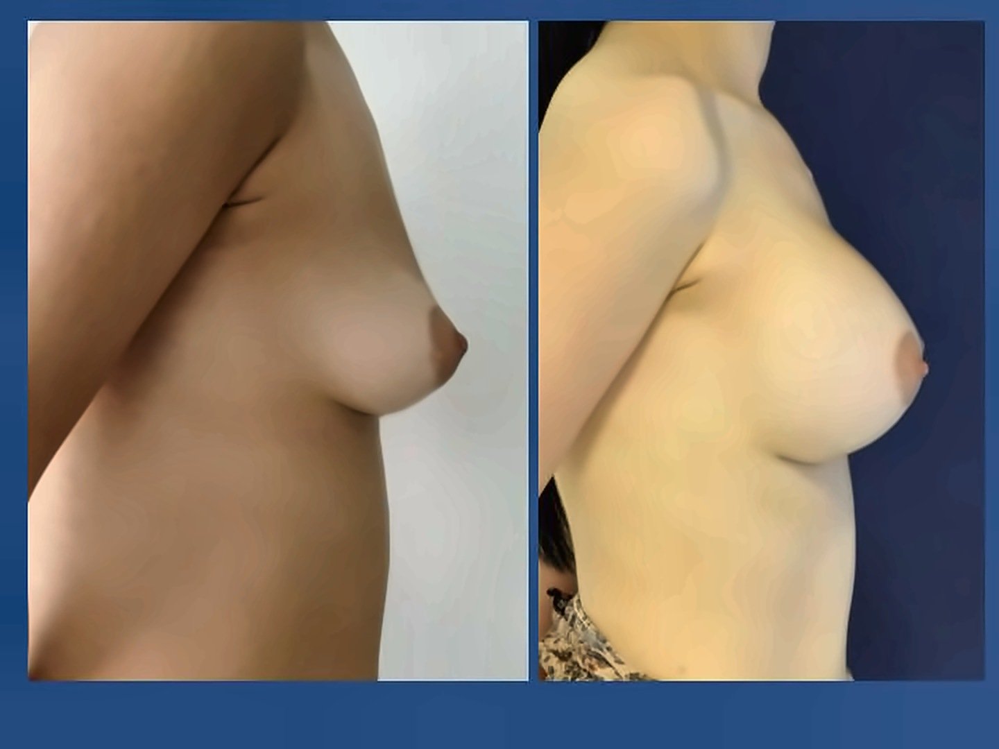 Before and after result by Dr. Ergin Er