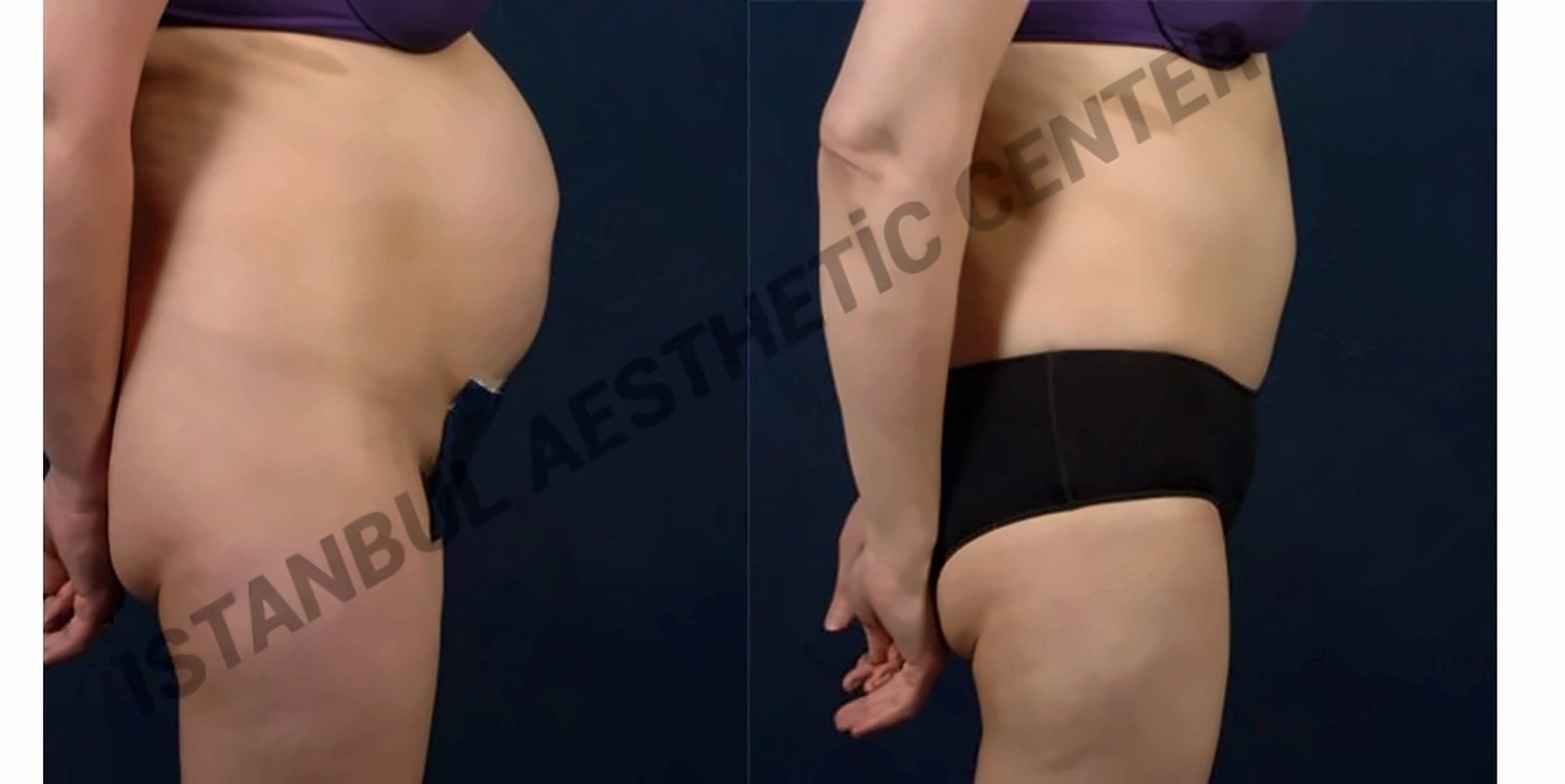 Before and after result by Dr. Ergin Er