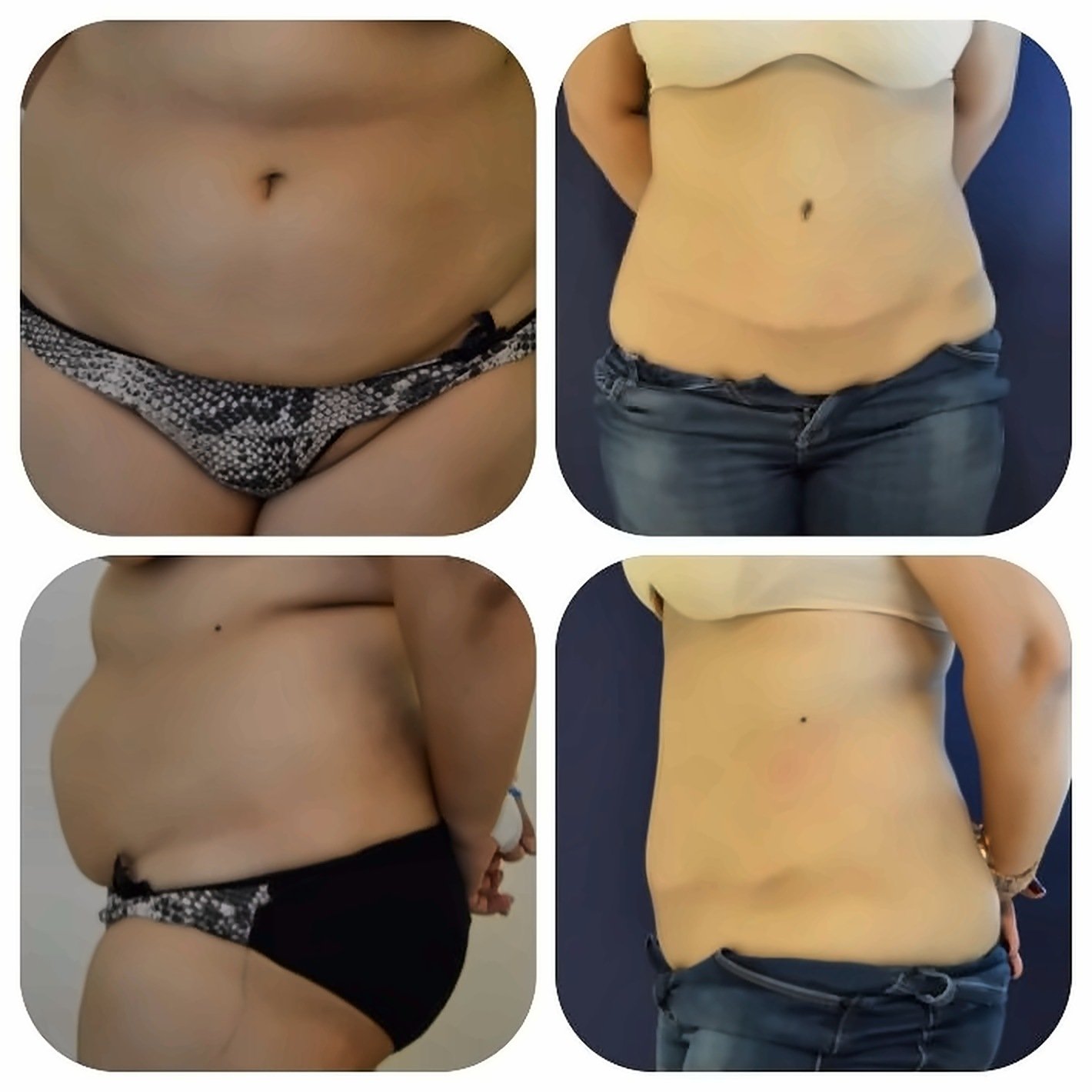 Before and after result by Dr. Ergin Er