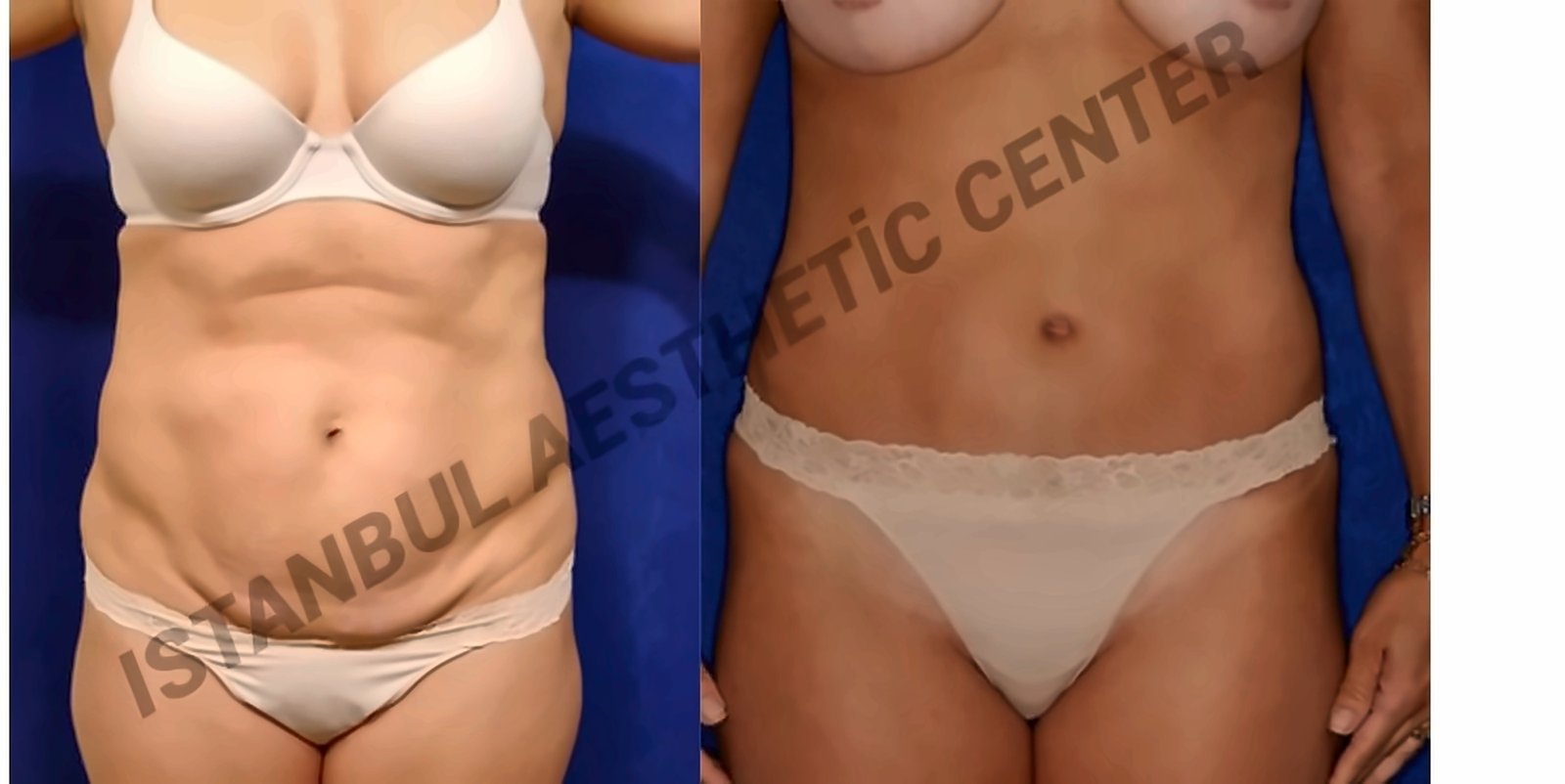 Before and after result by Dr. Ergin Er