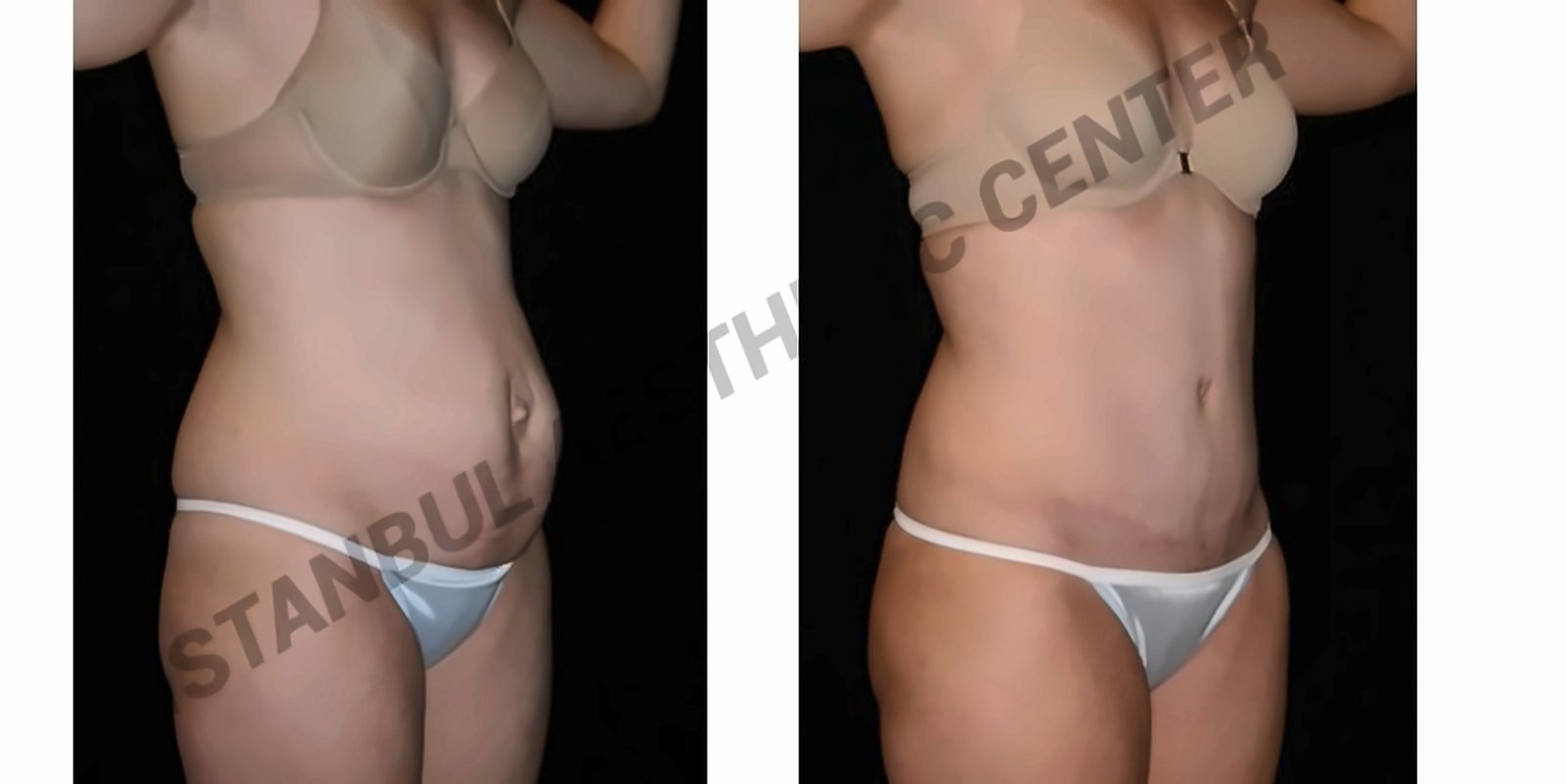 Before and after result by Dr. Ergin Er