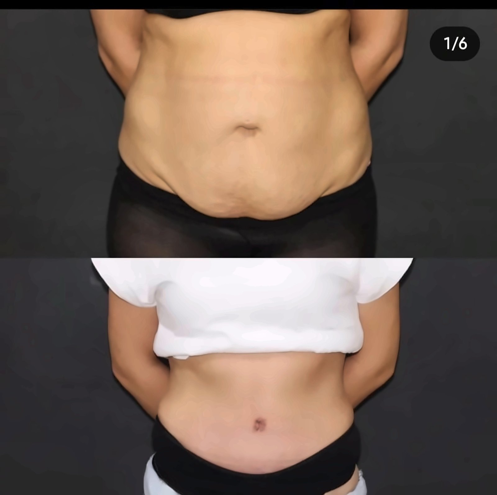 Before and after result by Dr. Ergin Er