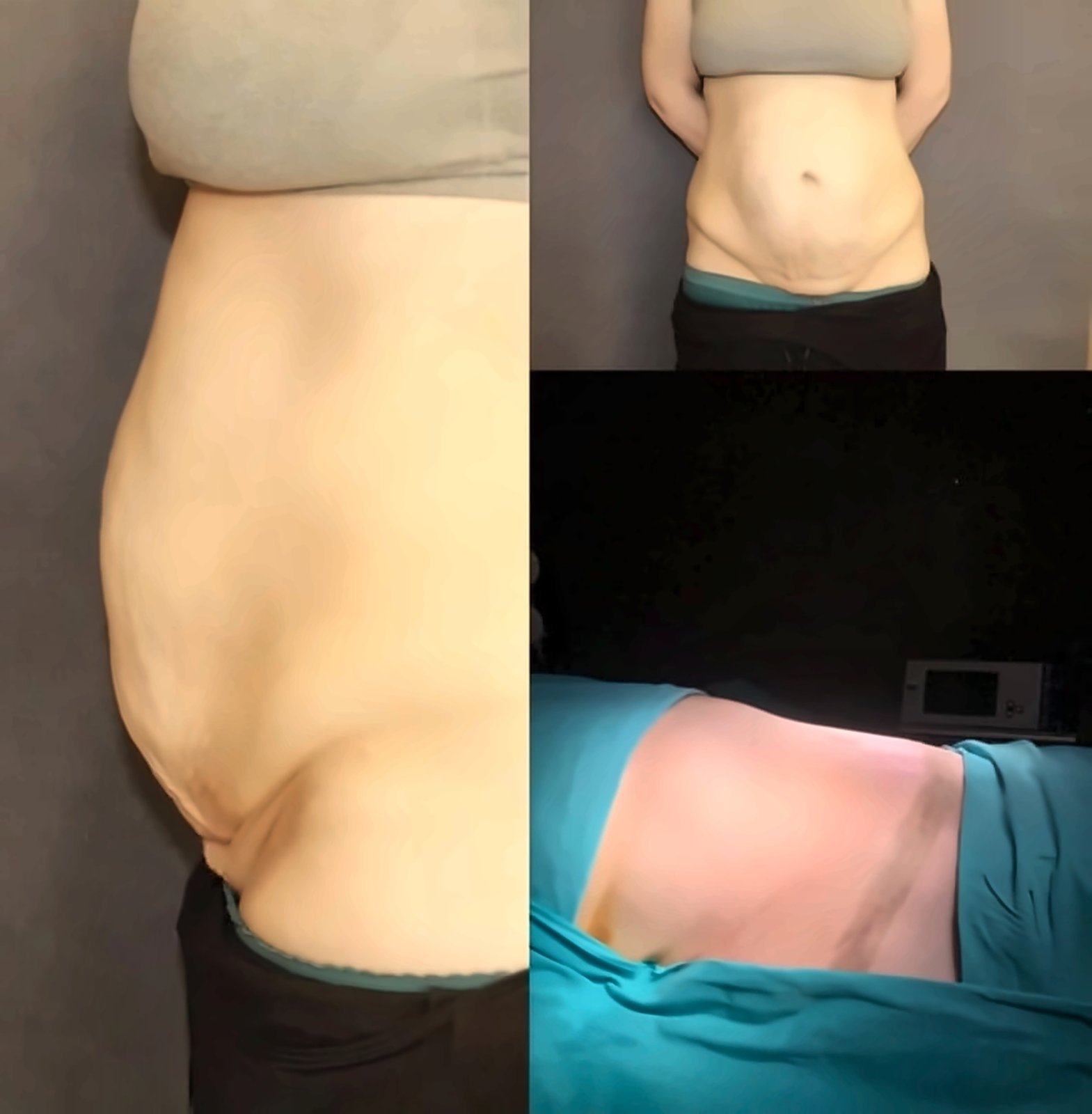 Before and after result by Dr. Ergin Er