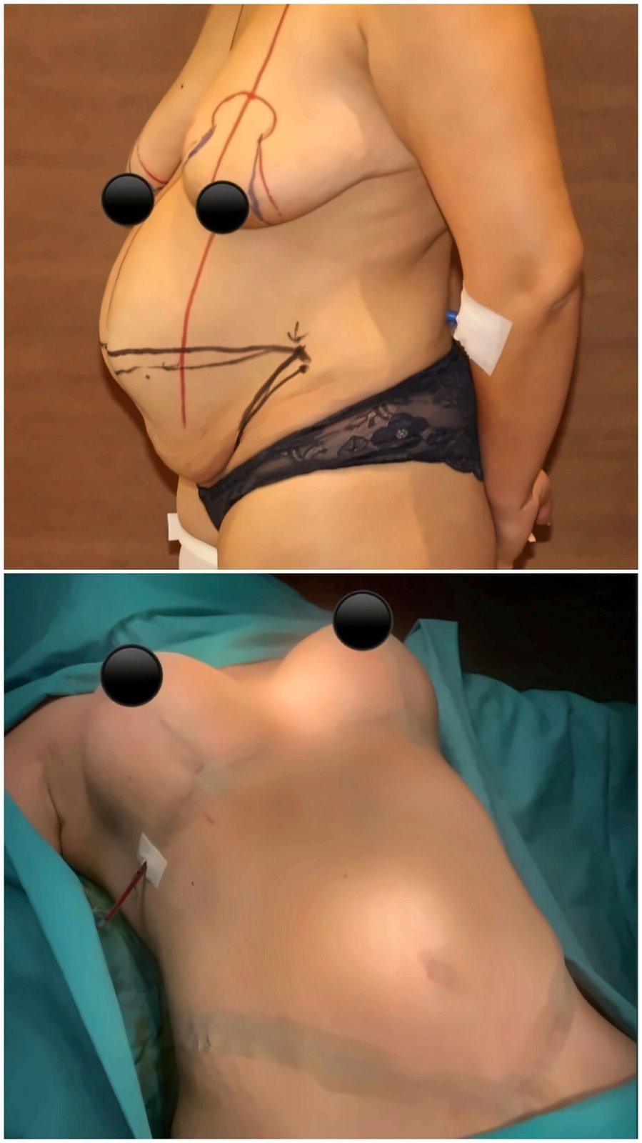 Before and after result by Dr. Ergin Er
