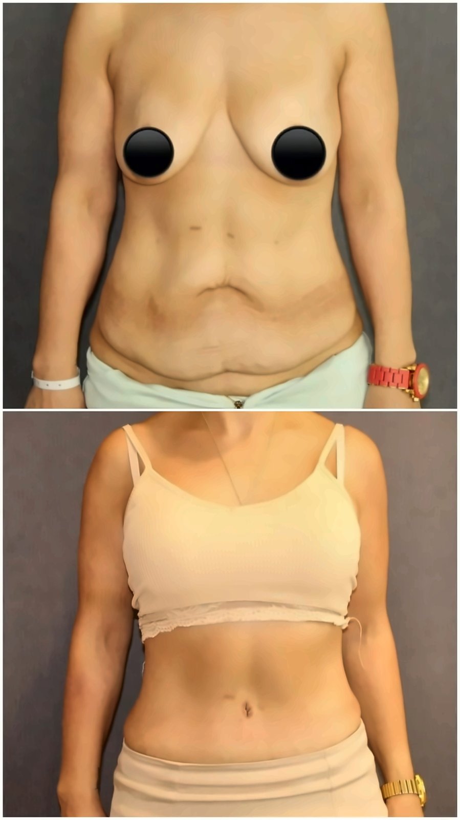 Before and after result by Dr. Ergin Er
