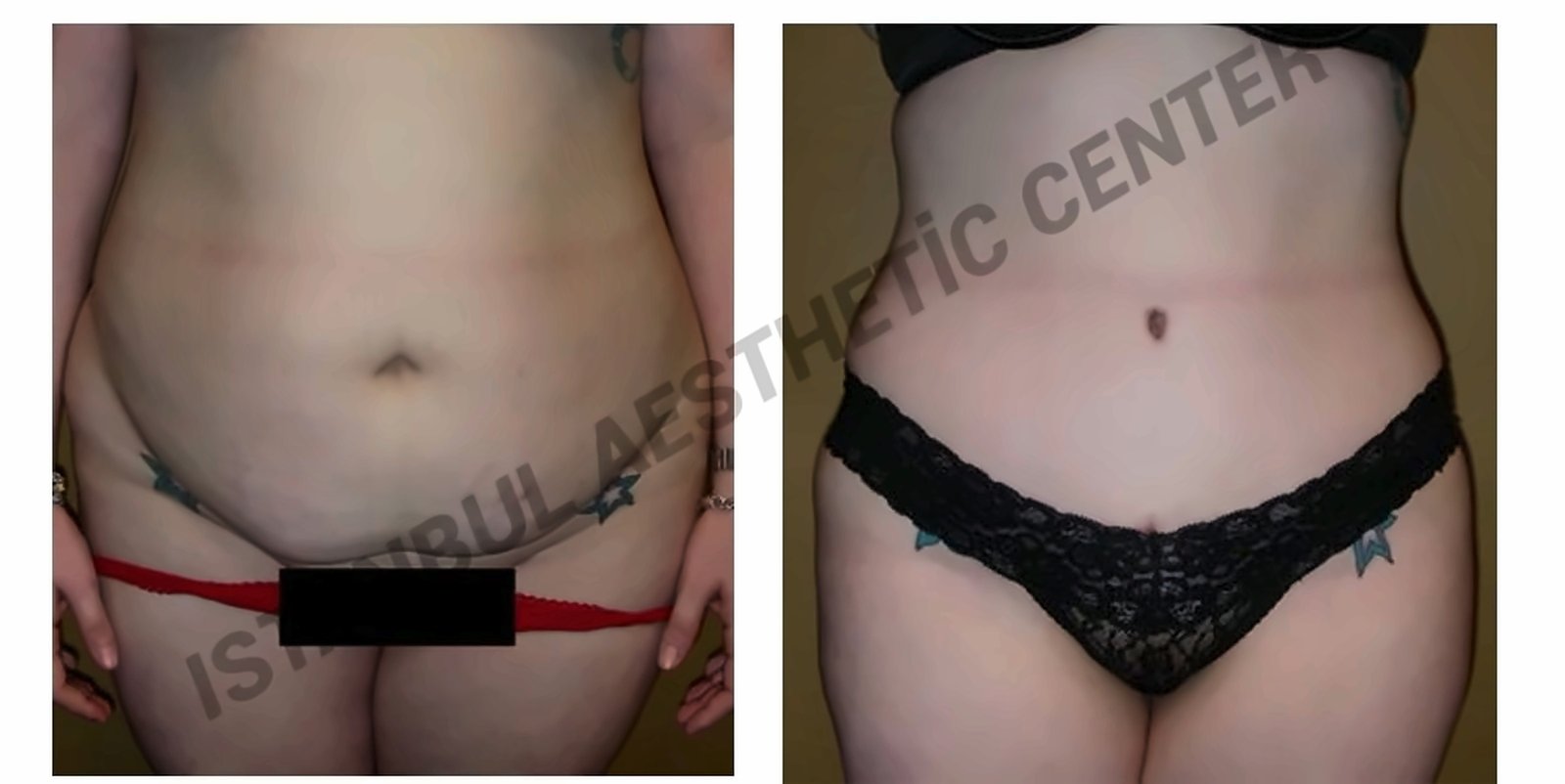 Before and after result by Dr. Ergin Er