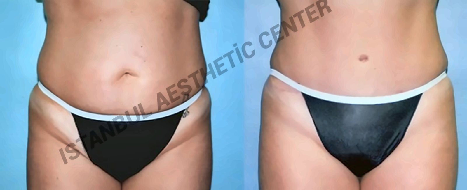 Before and after result by Dr. Ergin Er