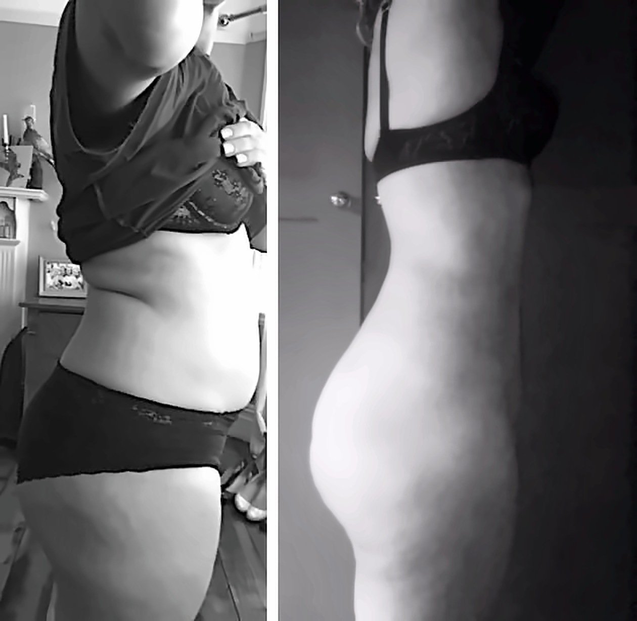 Before and after result by Dr. Ergin Er