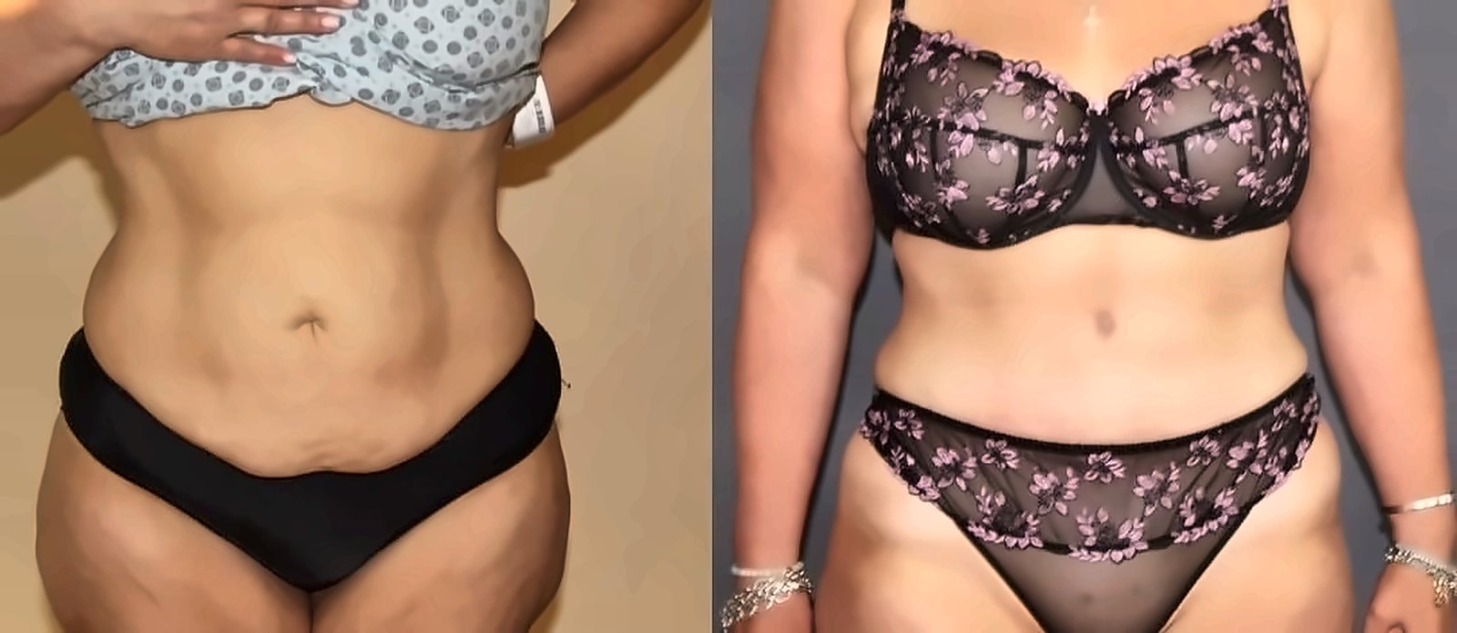 Buttock Augmentation (BBL)