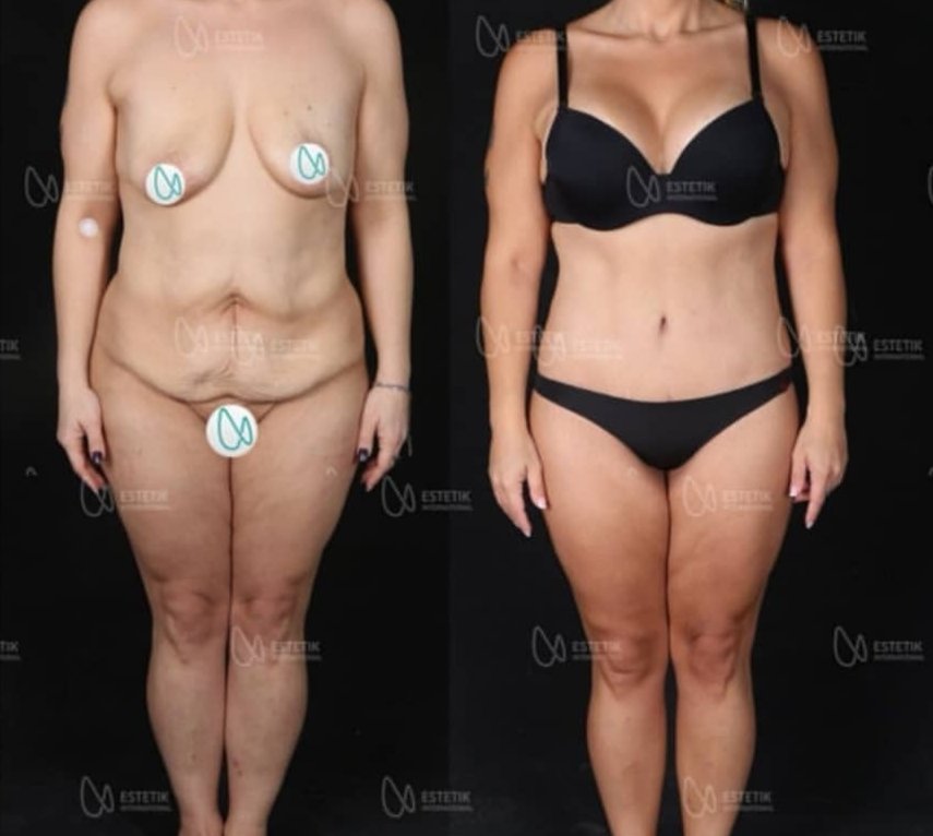 Before and after result by Dr. Selçuk Aytaç