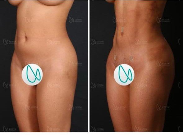 Before and after result by Dr. Selçuk Aytaç