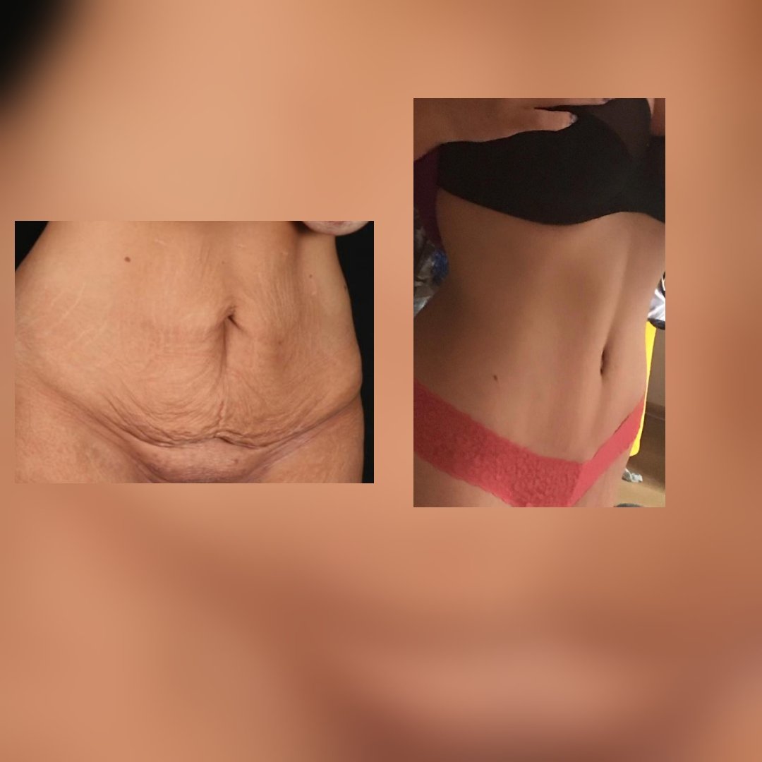 Before and after result by Dr. Selçuk Aytaç