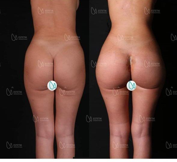 Before and after result by Dr. Selçuk Aytaç