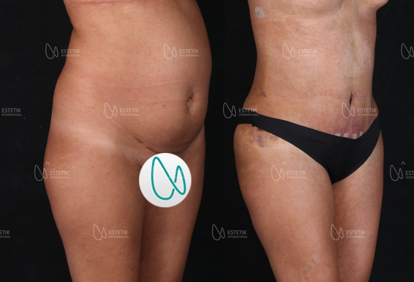 Before and after result by Dr. Selçuk Aytaç