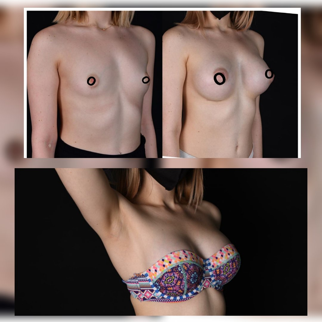 Before and after result by Dr. Selçuk Aytaç
